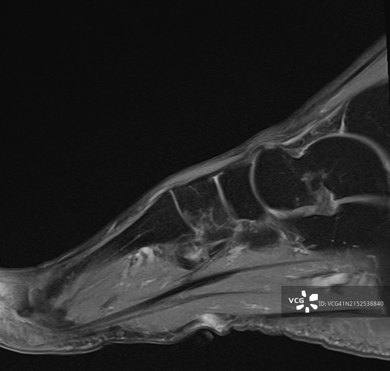 足底纤维瘤核磁共振成像图片素材