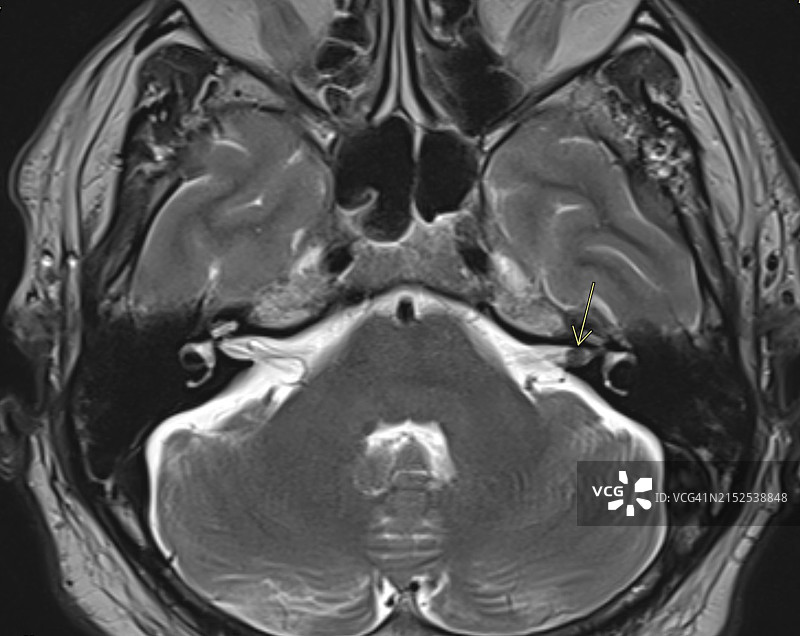 左侧内听道听神经瘤T2轴位MRI图像图片素材
