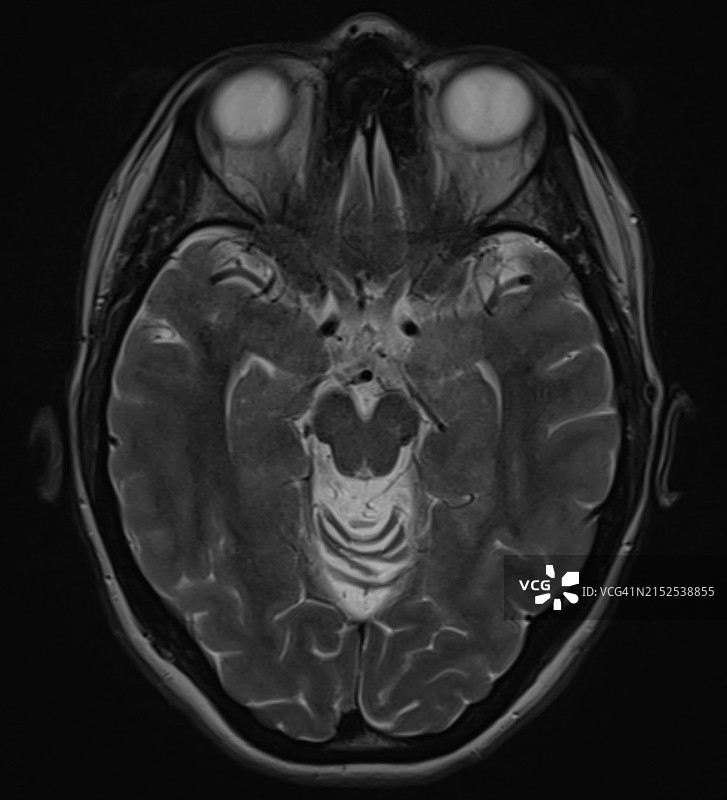 轴位T2 MRI图像显示弥漫性小脑萎缩图片素材