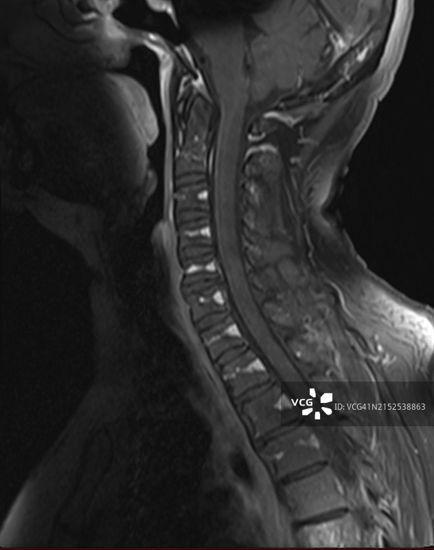 MRI磁共振成像显示基底椎静脉扩张，模仿成骨细胞病变图片素材