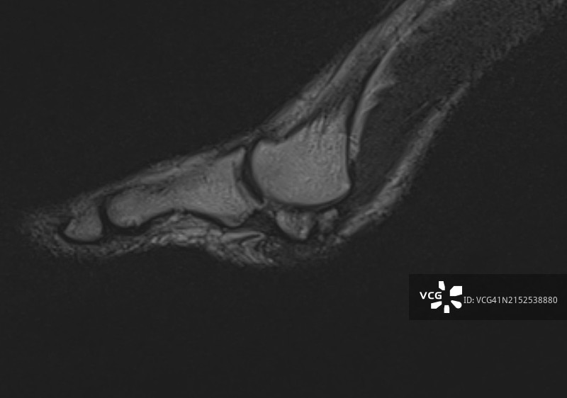 MRI磁共振图像显示的伴有籽骨炎的双分内侧拇籽骨，侧视图图片素材