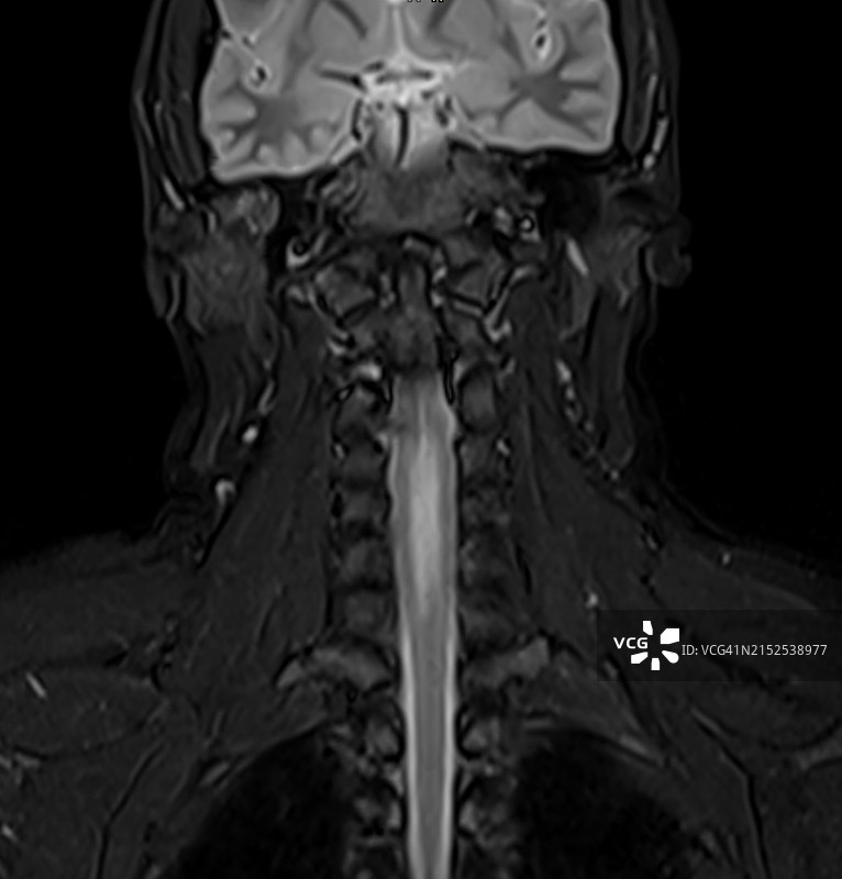 横贯性脊髓炎的典型MRI表现图片素材