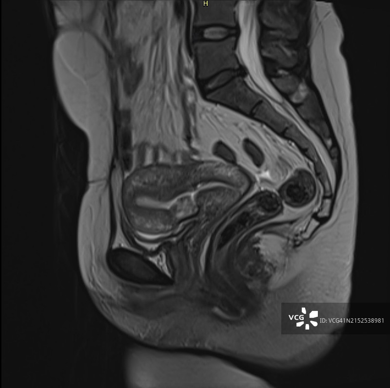 T2矢状MRI图像显示的剖腹产疤痕憩室或子宫峡部膨出图片素材