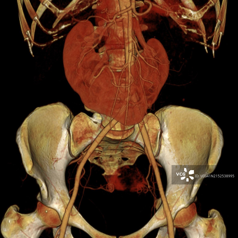 马蹄肾3D CT图片素材