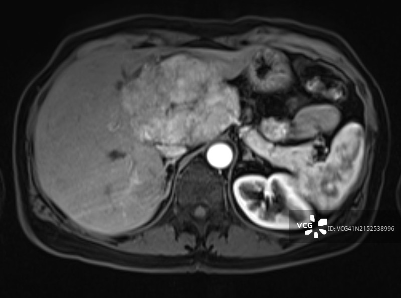 肝脏结节性增生的核磁共振成像图片素材