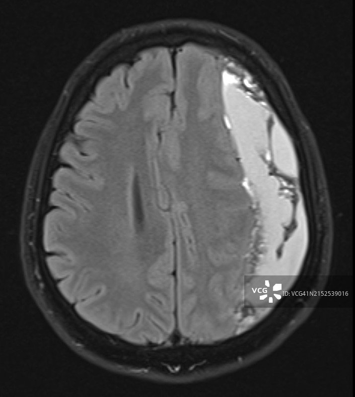 左侧硬膜下血肿的MRI影像（轴位图）图片素材