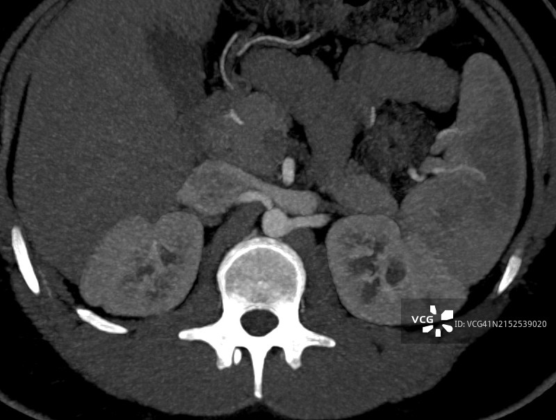 膈肌脚的肾血管压迫：肾血管性高血压图片素材