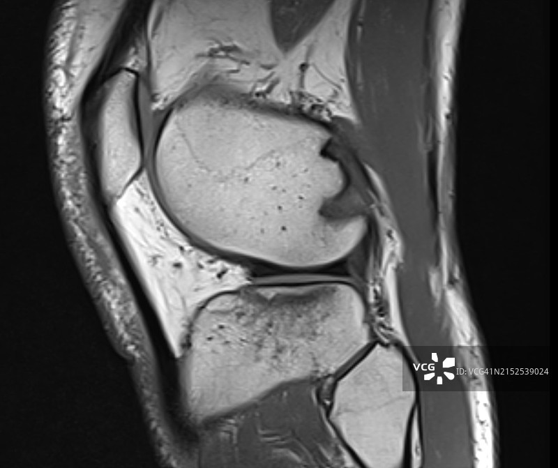 磁共振成像在胫骨平台骨折术前诊断中的价值图片素材