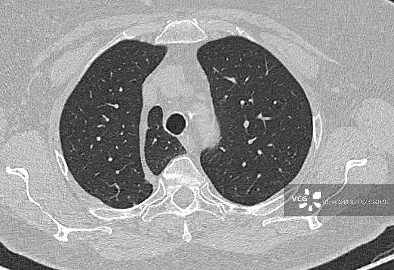 肺部CT扫描罕见解剖变异：奇静脉裂和奇静脉叶图片素材