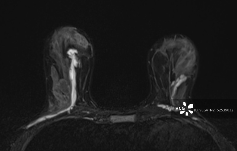 隆胸与凝胶注射：核磁共振成像中凝胶注射隆胸的影像学表现图片素材