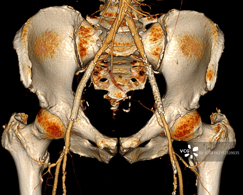 髂动脉双侧支架应用后的螺旋CT血管造影图片素材