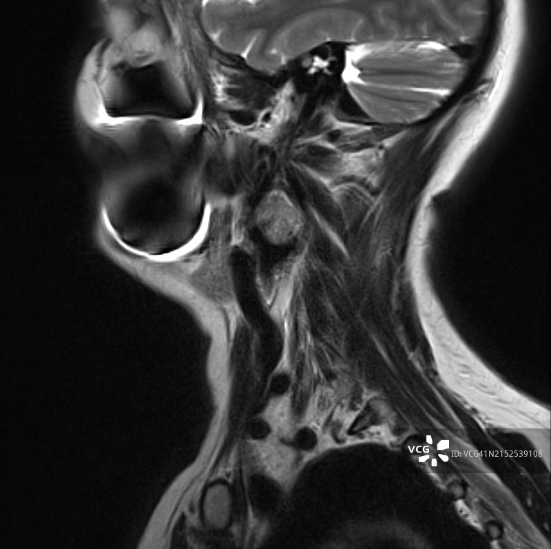 颈动脉体瘤的MRI图像图片素材