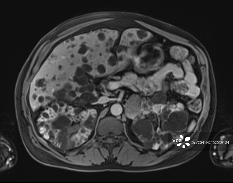 核磁共振成像显示肝肾囊性综合征图片素材