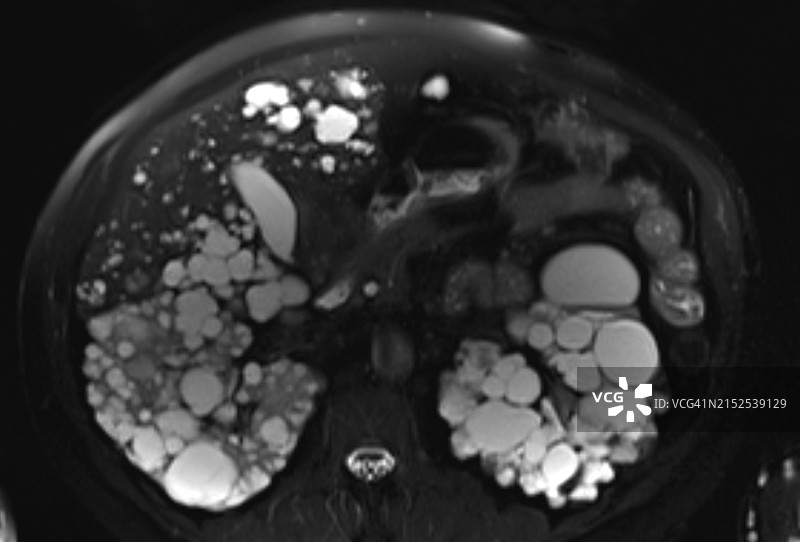 核磁共振成像显示肝肾囊性综合征图片素材