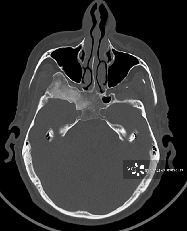 蝶骨纤维结构不良轴向CT图像图片素材