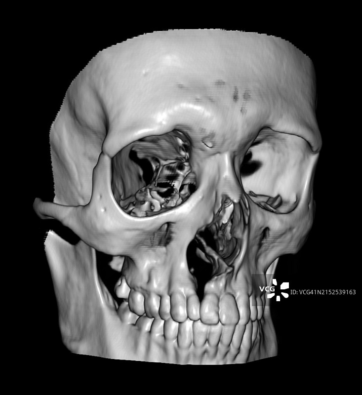 CT图像上显示的典型唇裂和腭裂图片素材