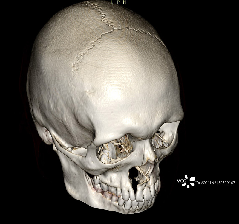 CT图像上显示的典型唇裂和腭裂图片素材