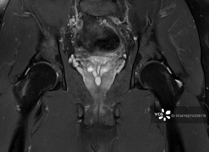 MRI在诊断前列腺尿囊肿中的应用图片素材
