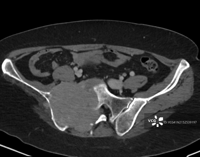 计算机断层扫描图像CT上显示的溶骨性骶骨病变图片素材