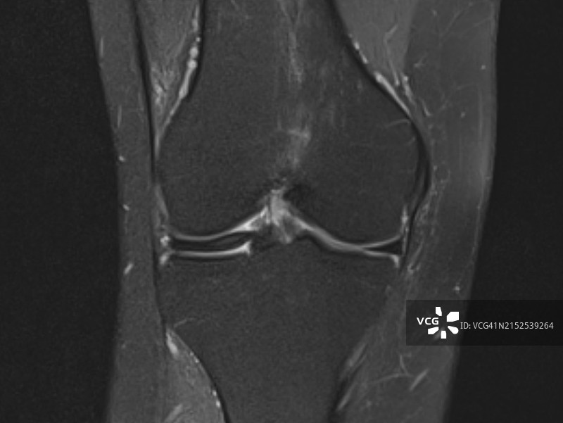 膝关节盘状半月板：冠状位MR成像表现图片素材