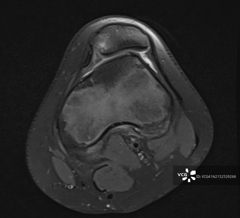 轴向磁共振成像MRI显示的滑车发育不良图片素材