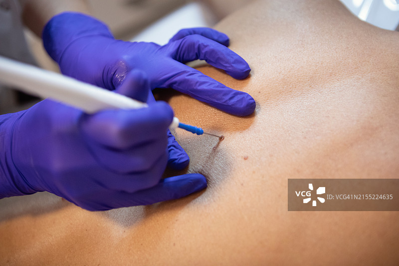 皮肤科医生使用激光电凝器去除患者的痣图片素材