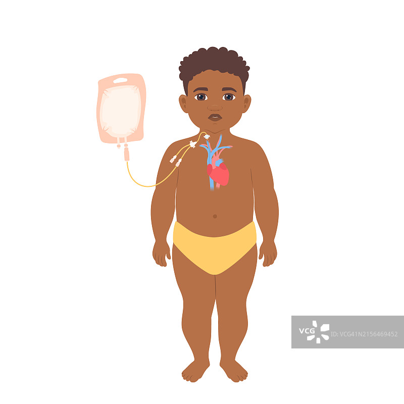 儿童接受肠外营养，图示图片素材