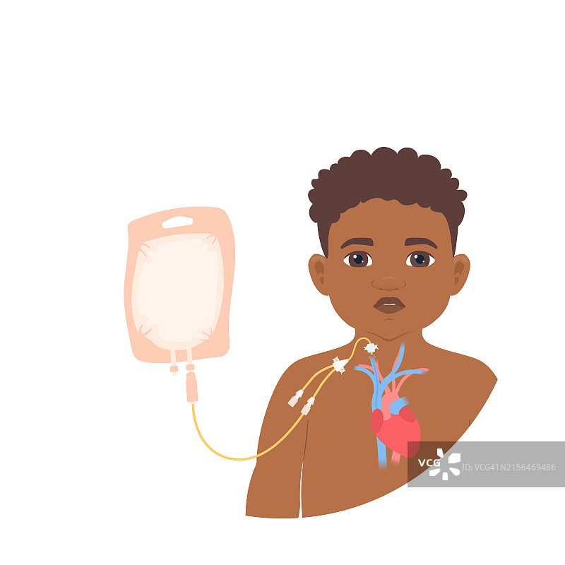 儿童接受肠外营养，图示图片素材