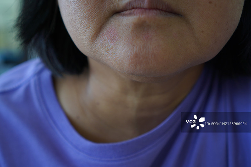 下巴上的红肿图片素材