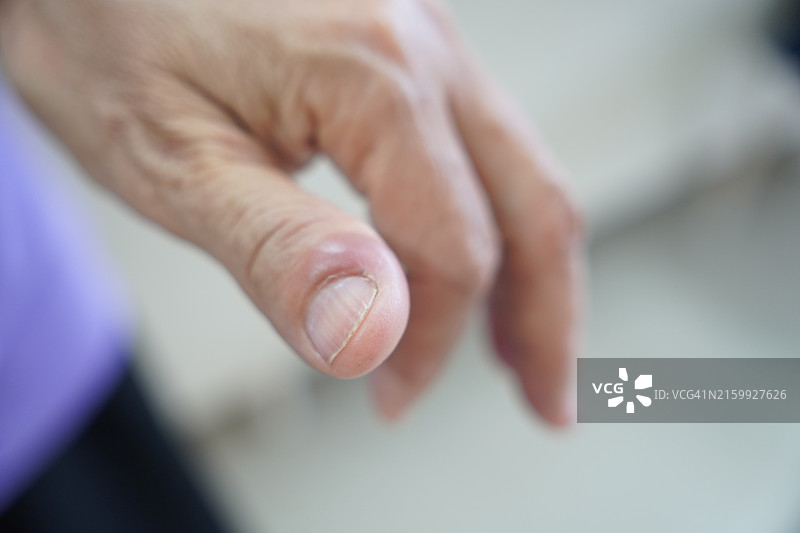 拇指上的疮图片素材