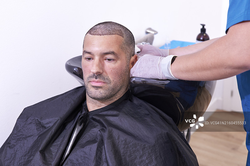 外科医生移除植发患者头部的结痂图片素材