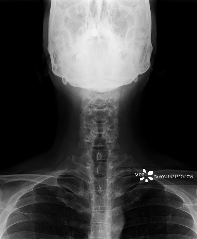 颈部X光背面图图片素材