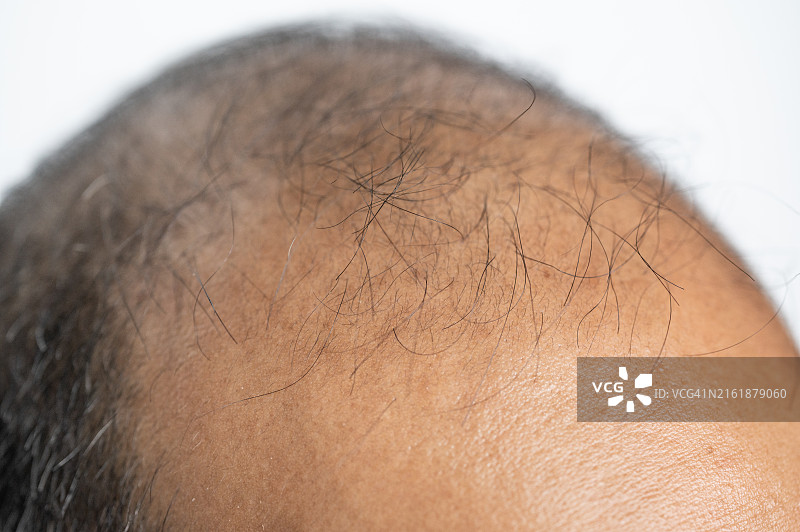 亚洲男性稀疏头发的头皮局部照片图片素材