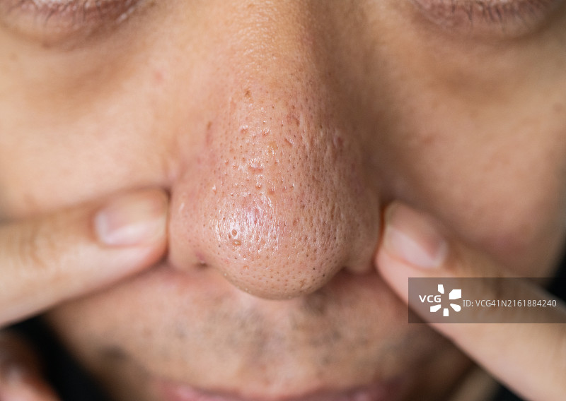 亚洲男人鼻子上的毛囊和毛孔图片素材