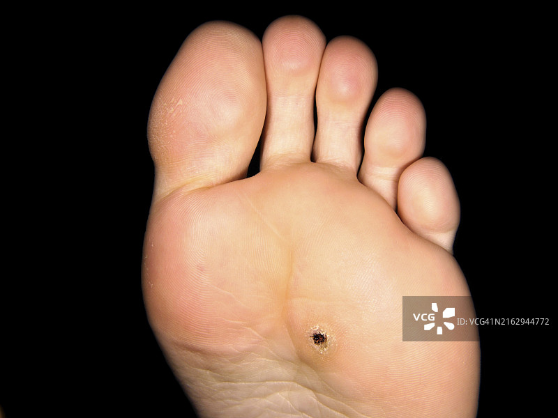 足底老茧，黑色背景图片素材