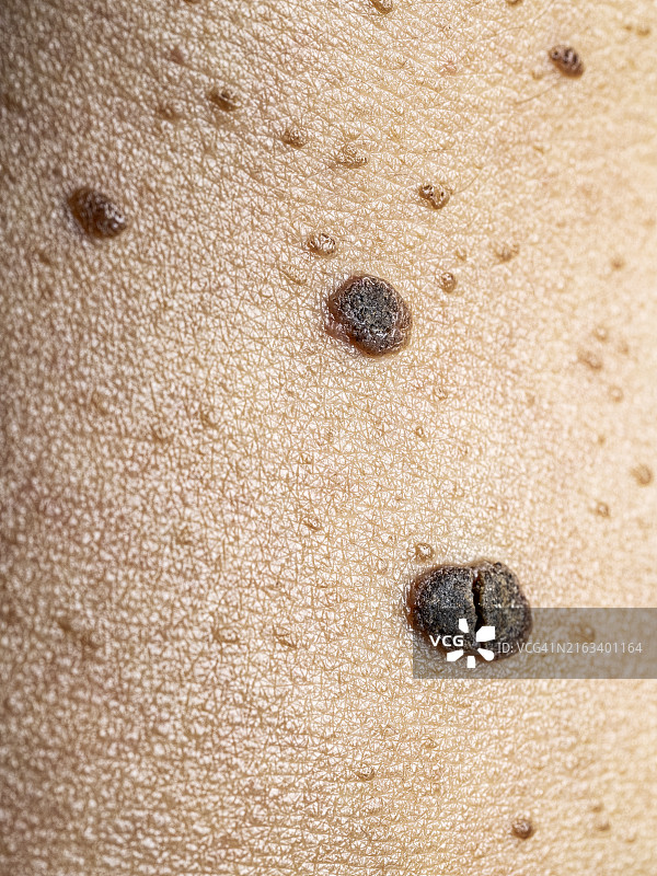 成年男性的皮肤，有大量雀斑图片素材