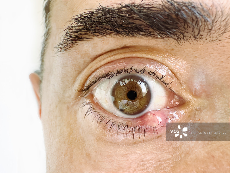 男人患有霰粒肿的感染眼睛特写图片素材