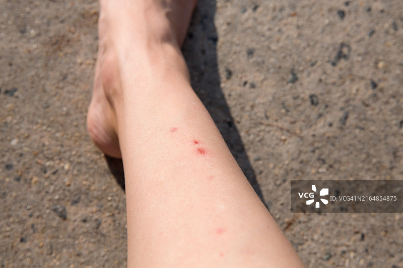 剃须后腿部结痂的女人图片素材