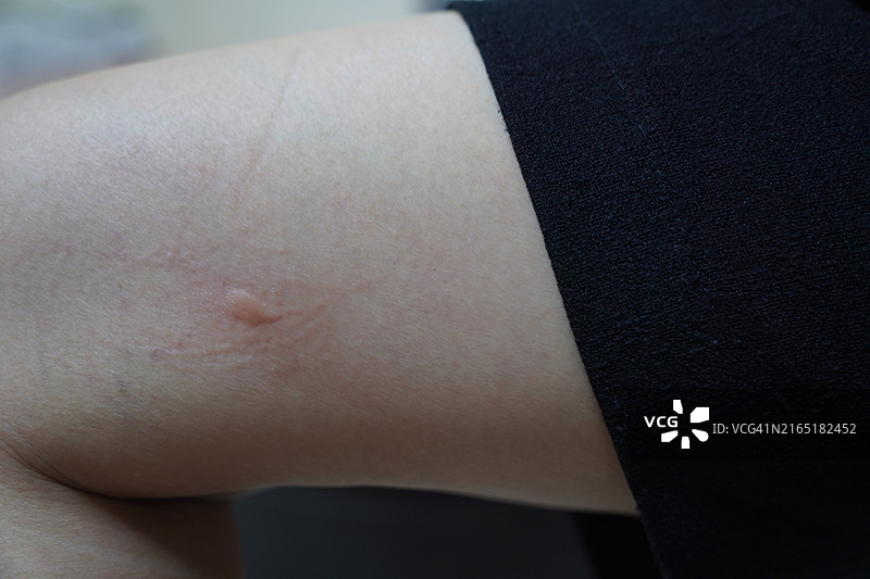 大腿上蚊虫叮咬导致肿胀图片素材