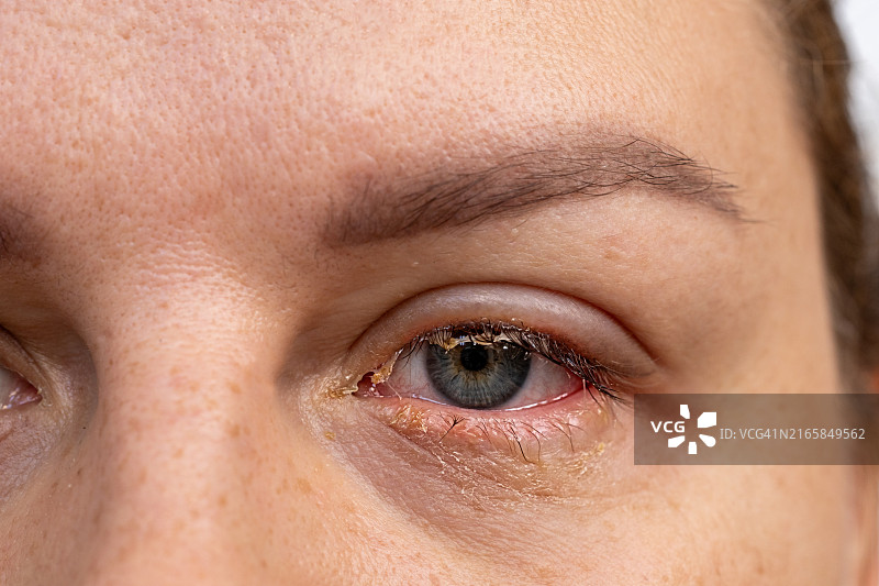 有脓液和感染的红眼图片素材