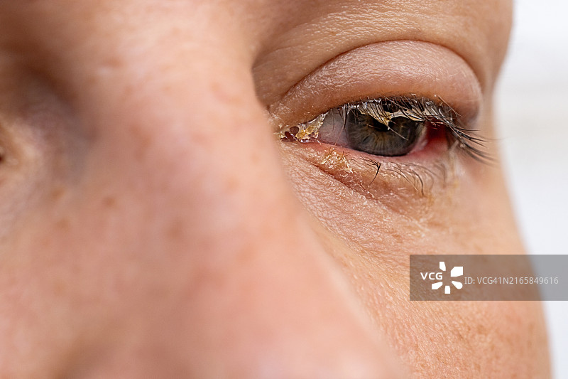 结膜炎眼睛的特写镜头图片素材