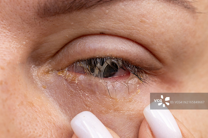 女人眼睛红肿感染的特写图片素材