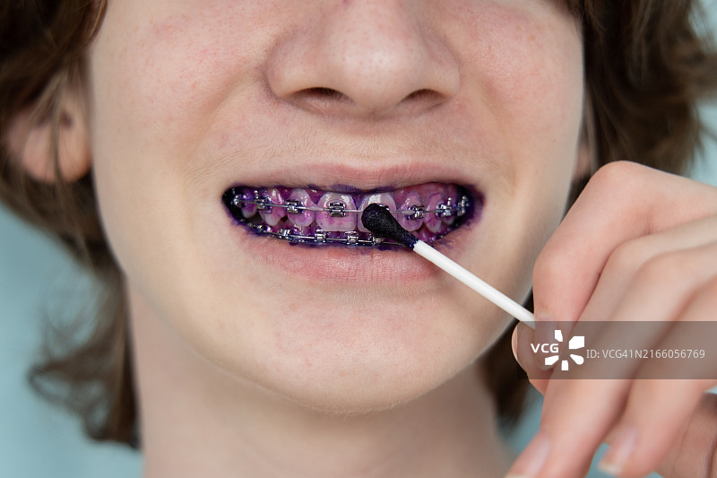 牙齿矫正菌斑指示牌图片素材