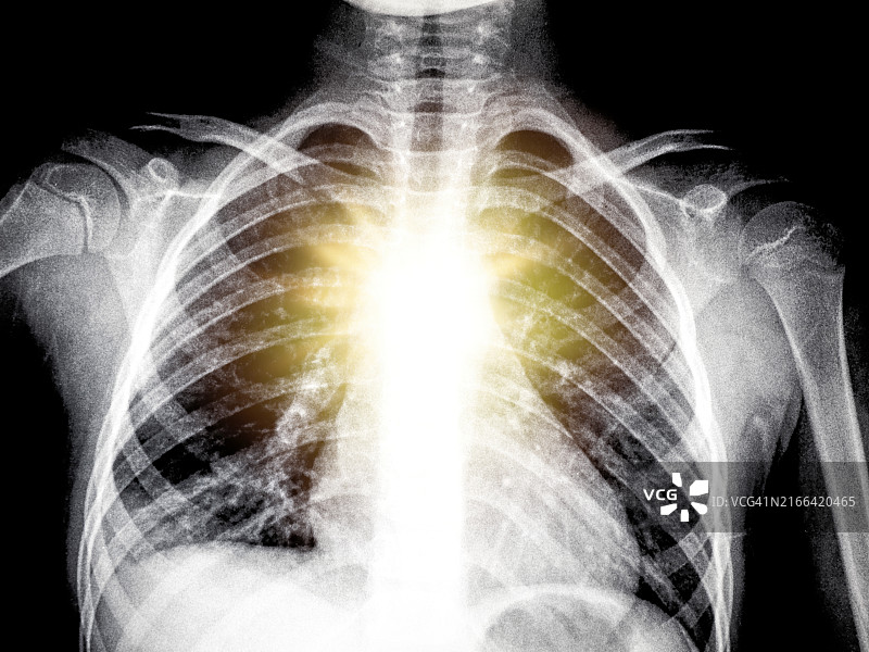 年轻女性肺炎胸部的X光图像，伴有疼痛感图片素材