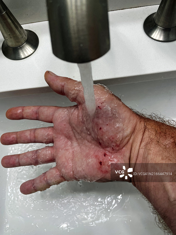 清洗手上的伤口图片素材