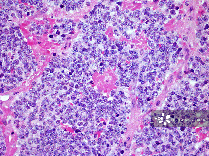 肾上腺神经母细胞瘤恶性肿瘤在300倍放大倍数下，用苏木精和曙红染色的显微图像，是影响儿童的最常见癌症之一图片素材
