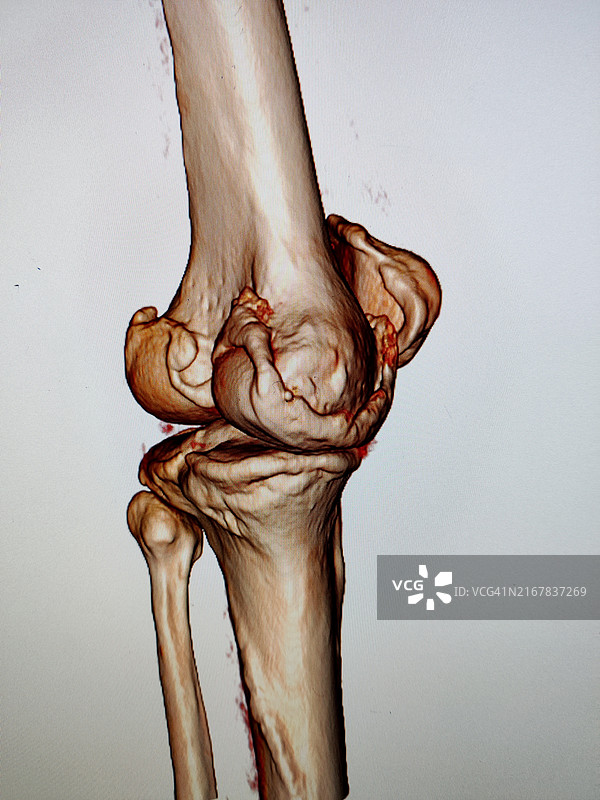 膝关节镜下经胫骨隧道后交叉韧带重建图片素材
