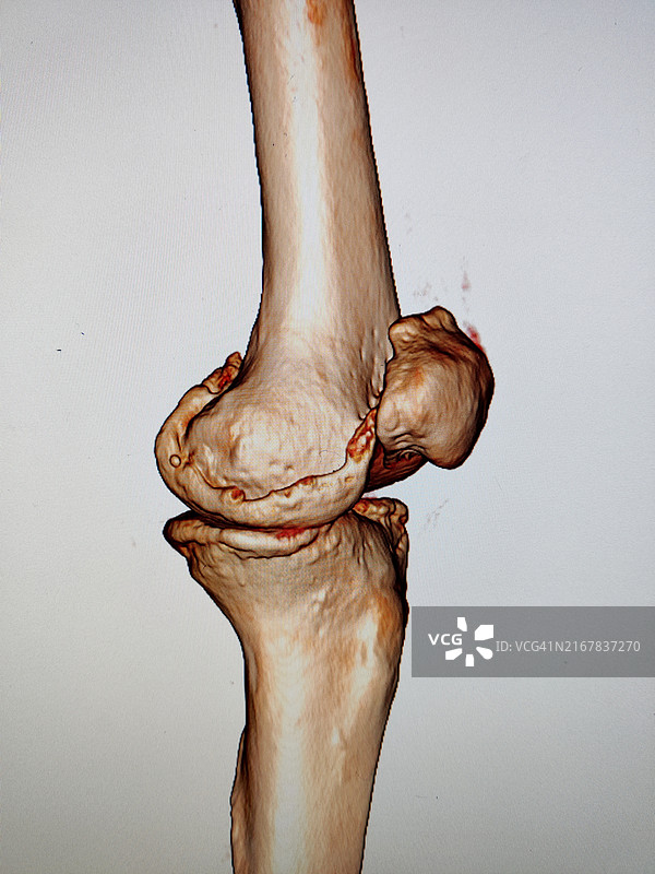 膝关节镜下经胫骨隧道后交叉韧带重建图片素材