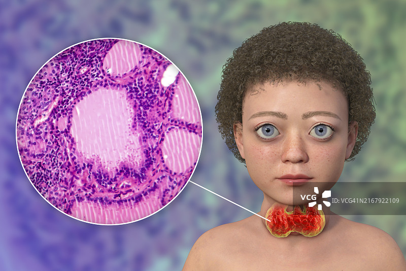 患有格雷夫斯病的孩子，插图图片素材