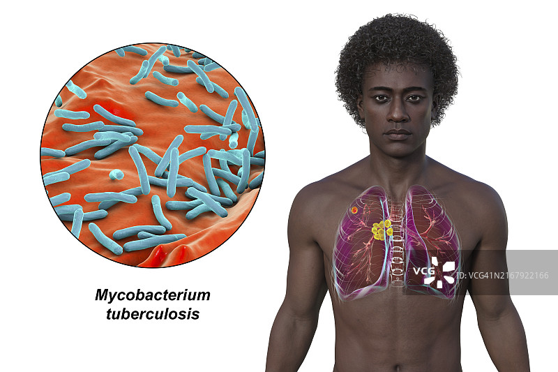 原发性肺结核插图图片素材